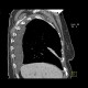 Amiodarone liver: CT - Computed tomography